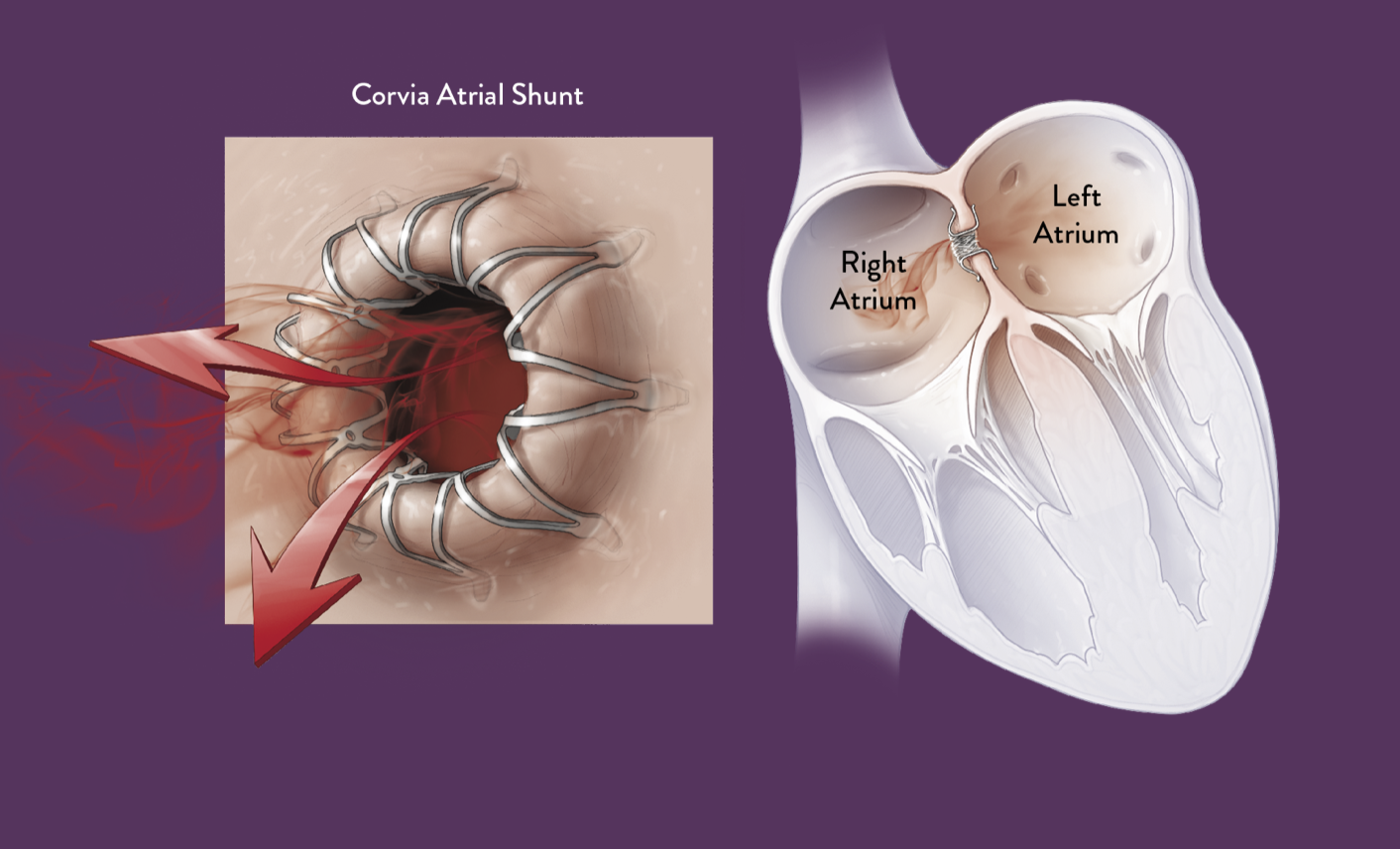VIDEO: Overview of intra-atrial shunts to treat heart failure