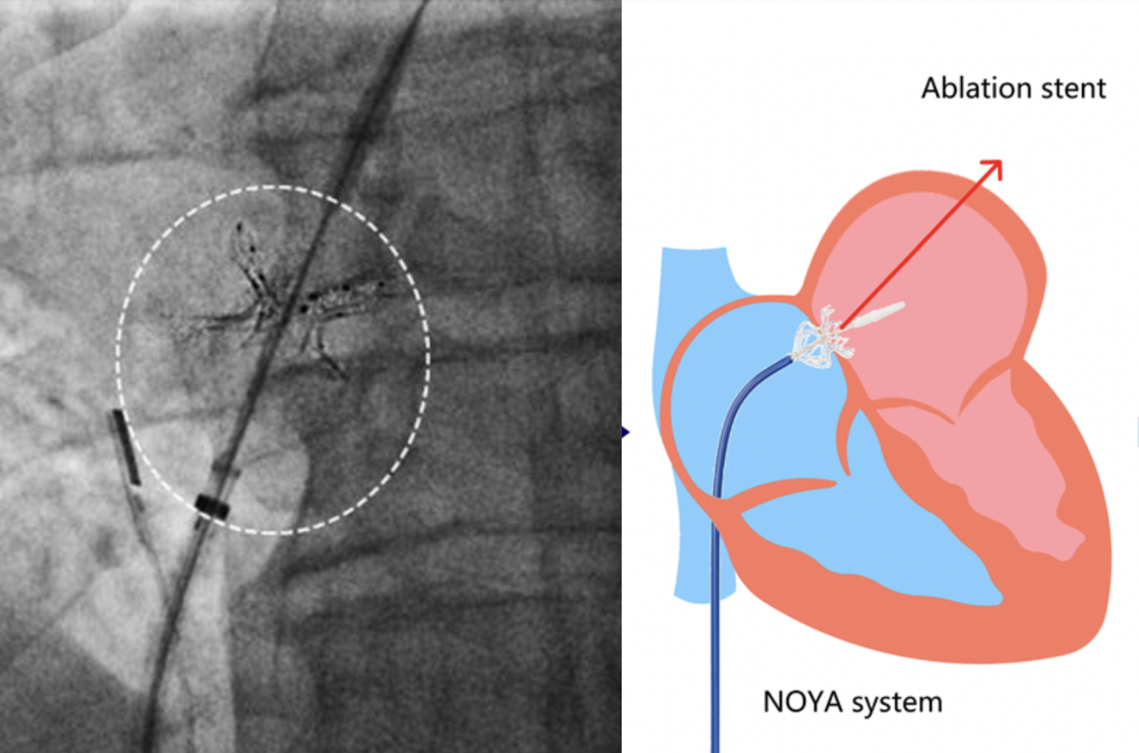 Researchers share first human data on new interventional shunt procedure  for HFpEF