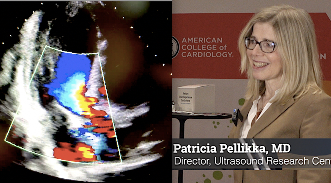 Q&A: The value of strain for echocardiography - Ultromics