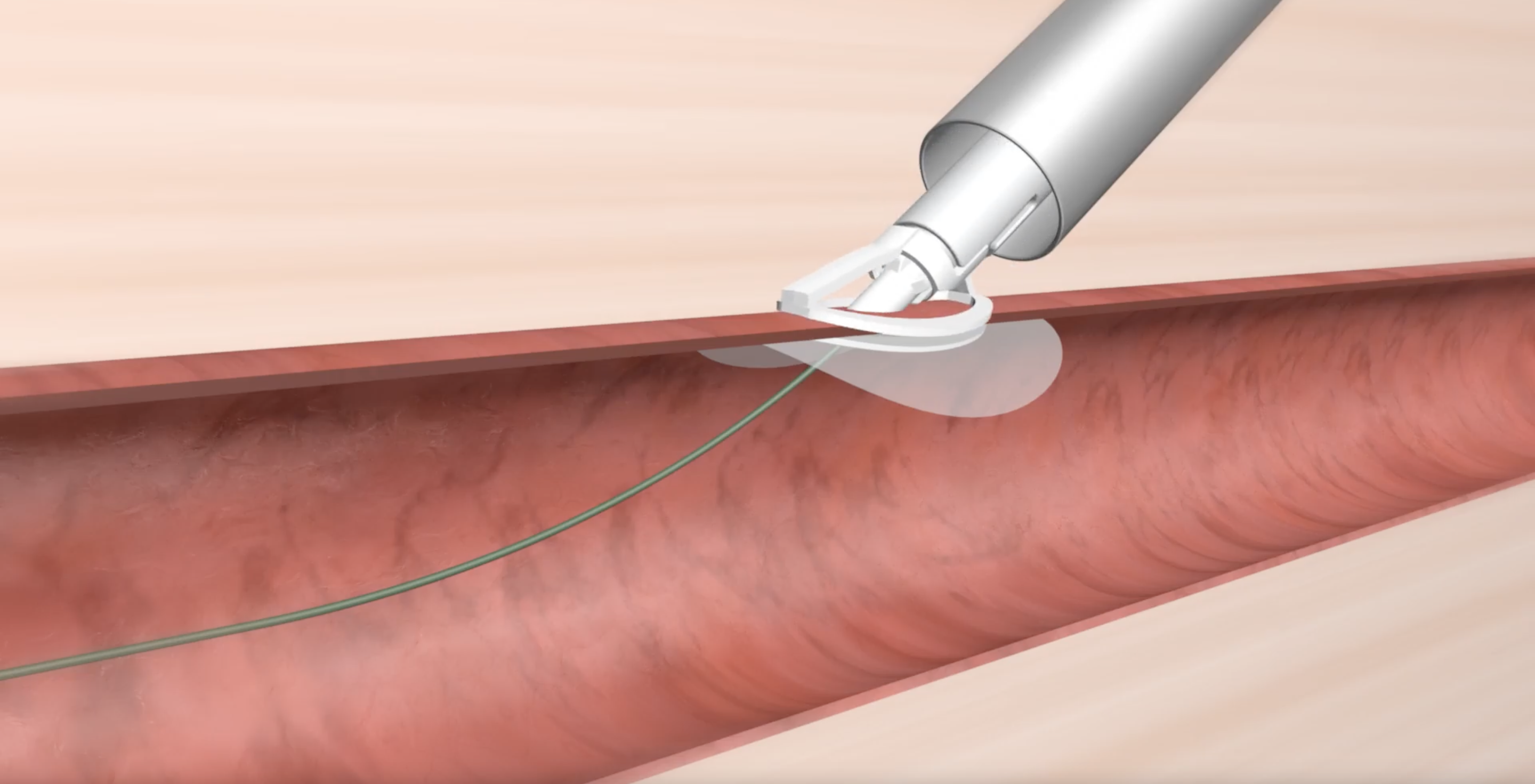 Haemonetics acquires Irish medtech company focused on vessel closure