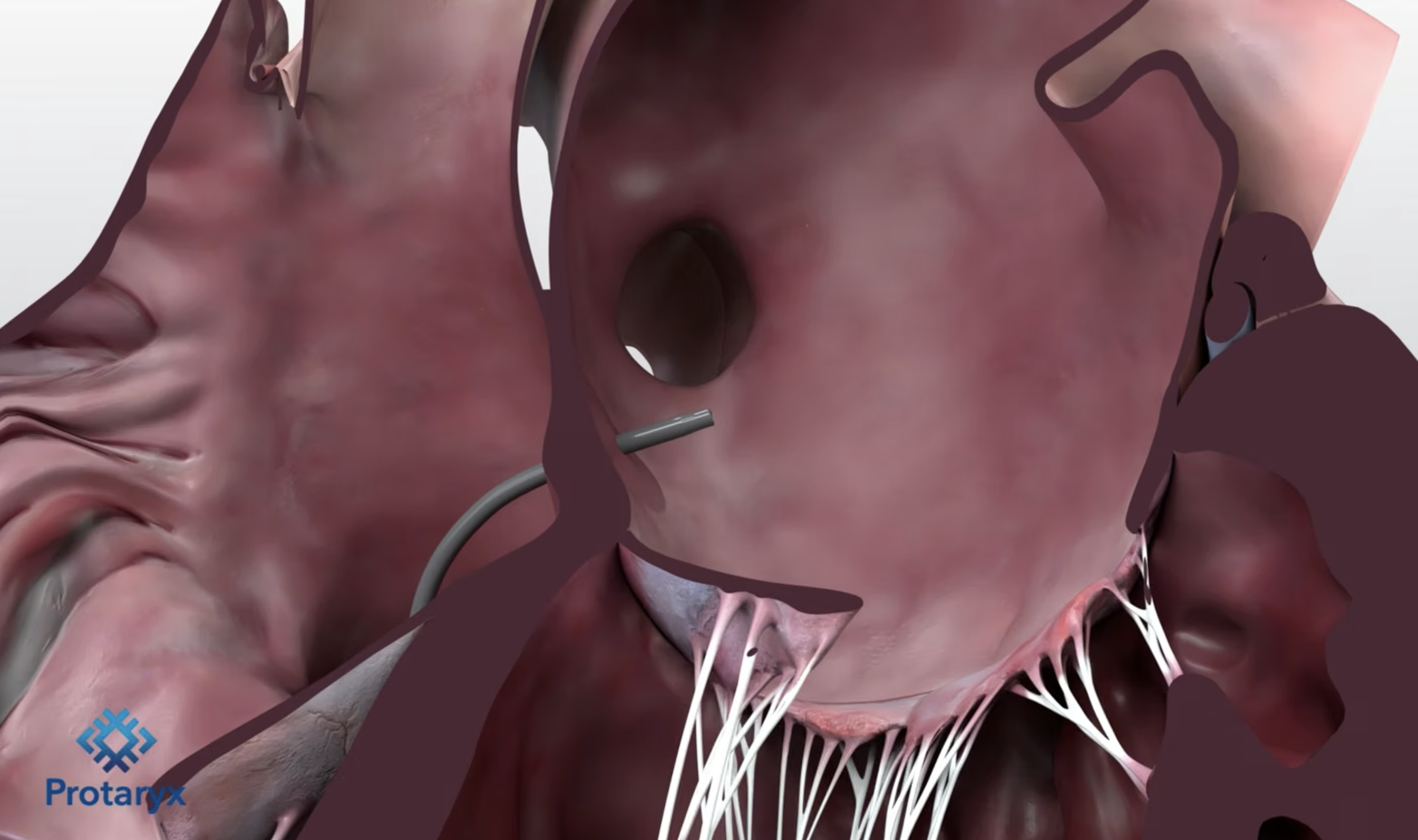 FDA clears next-gen device for left-heart access