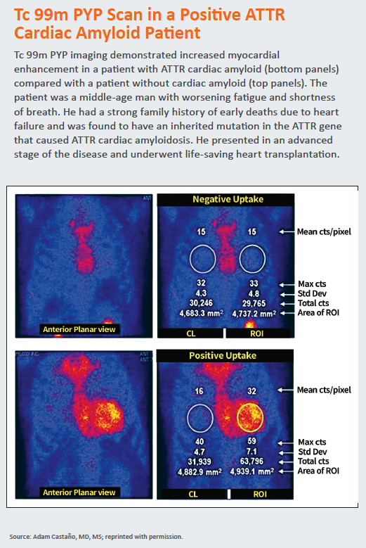 Resurrecting Tc 99m As Cardiac Amyloidosis Therapies Emerge, Old Test Gains a New Purpose