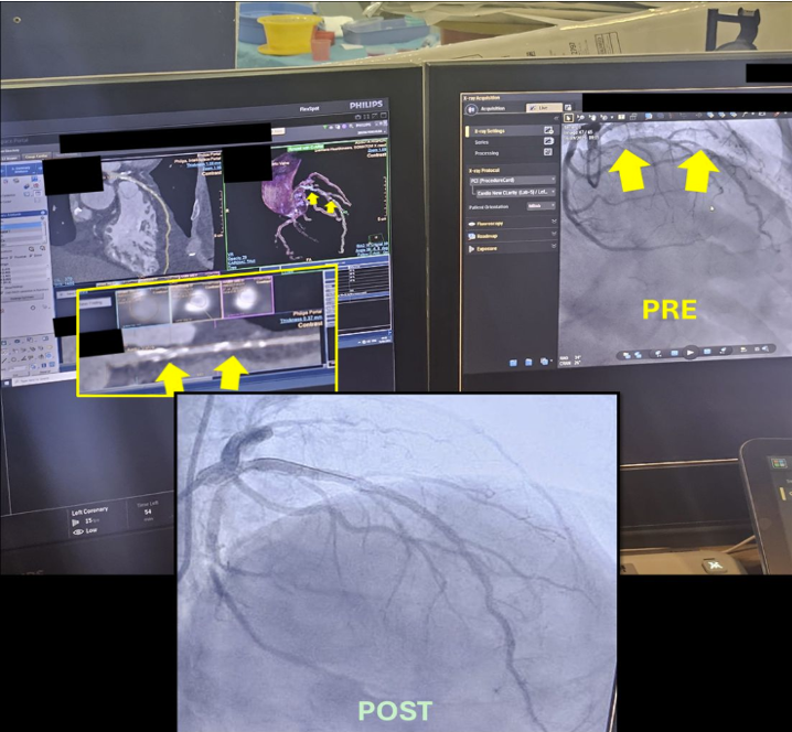 CT-Guided PCI