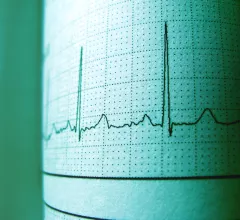 Electrocardiograms analyzed by AI can offer information about mortality risk.