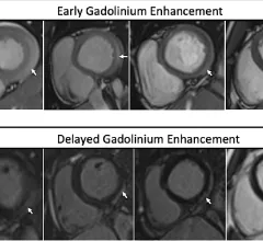 Myocarditis as seen on cardiac MRI in patients who recently received COVID-19 messenger RNA vaccination from a November 2021 imaging study. Image courtesy of the American Journal of Roentgenology (AJR)