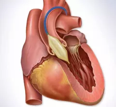 Balloon valvuloplasty months after implantation is a safe and effective treatment option for patients with transcatheter heart valve (THV) dysfunction, according to a new analysis published in the Journal of the American College of Cardiology