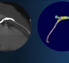 Left, coronary CT angiography of a vessel showing plaque heavy calcium burden. Right, image showing color code of various types of plaque morphology showing the complexity of these lesions. The right image was processed using the FDA cleared, AI-enabled plaque assessment from Elucid.