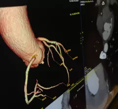 Example of a patient's coronary tree extracted from a cardiac CT scan. CT allows very detailed anatomical imaging and now physiological and plaque information that can be useful in pre-planning interventional procedures. Imaging from the GE Revolution Apex system at SCCT 2022.