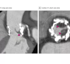 Subclinical leaflet thrombosis after TAVR imaged by CT. The areas of clot attached to the valve leaflets appear dark. Image courtesy of Cahill et al. and JAMA Cardiology.