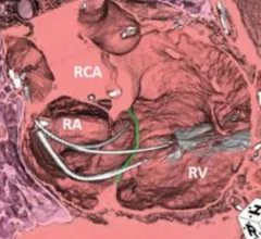 The tricuspid valve anatomy is ofrten complicated for transcatheter structural heart interventions (TTVR) by the placement of pacemaker or ICD leads.