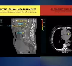 Examples of the messages the Nanox AI algorithms display for incidental findings of spinal compression fractures and detection of coronary calcium. Both can help physicians better understand risk factors or need for therapy in patients through these types of opportunistic screenings on scans being performed for other reasons.