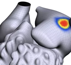 Atrial Fibrillation and its location in the atrium detected using the Vektor arrhythmia detection software. COVID infection can cause the development of AFib, AF, in patients as a long-COVID symptom. 
