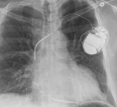 An example if an implantable cardioverter defibrillator (ICD and its leads connected to the heart. As the leads or deveice wears out, there are recommendations to remove the leads and put in new ones.  The most common causes of mortality during transvenous lead removal (TLR) in patients with cardiac implantable electronic devices (CIEDs) are infection and decompensated heart failure, according to new research published in JACC: Clinical Electrophysiology.Image courtesy of RSNA