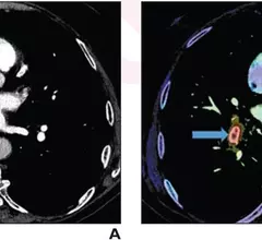 pulmonary embolism on CT pulmonary angiography