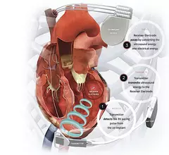 The EBR Systems WiSE leadless cardiac resynchronization therapy (CRT) system. #HRS23