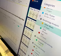 Artificial intelligence (AI) analysis from a remote ECG monitor showing the AI generated report on the Philips Cardiologs system, during a demonstration of the technology at Heart Rhythm 2023. Photo by Dave Fornell