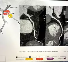 HeartFlow's RoadMap technology where AI reads the image in a first pass to highlight areas of interest with for the radiologist or cardiologist on coronary CT scan. The technology was shown to reduce reading time by 25%.
