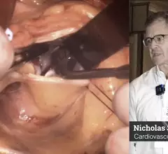 Nicholas Smedira MD discusses spetal myectomy in HCM patients and the need for more detailed protocols for HCM care. #HCM #ASE #ASE2023 #myectomy