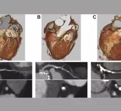 CTA images before TAVR to screen for coronary artery disease