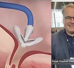 Video of Prof. Dr. Ralph Stephan von Bardeleben explaining the latest details from key tricuspid valve trials.