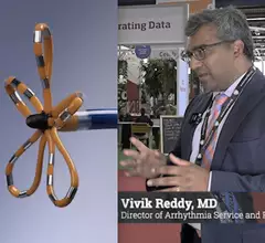 Vivik Reddy, MD, director of arrhythmia service and processor of medicine in cardiac electrophysiology, Mt. Sinai, New York, expolains the key takeaways from the ADVENT trial of pulsed field ablation at ESC 2023.