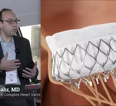 Firas Zahr, MD, Oregon Health and Science University, discusses the one-year outcomes for transfemoral transcatheter mitral valve replacement (TMVR) in the Medtronic Intrepid Early Feasibility Study presented at TCT 2023.