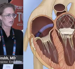 Video of Kendra Grubb discussing transcatheter tricuspid and mitral advancements at TCT 2023.