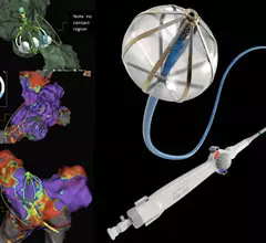 Pre-clinical images of the Abbott Volt pulsed field ablation system creating lesions using electroporation, presented at the 2023 AHA Scientific Sessions, The Abbott PFA system is now being used in a first-in-human study at the Centre for Heart Rhythm Disorders at the University of Adelaide, Australia.
