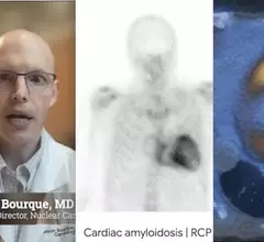 Jamie Bourque, MD, medical director of the nuclear cardiology and stress laboratory, and medical director of the echocardiography lab, at the University of Virginia, discusses a new multimodality consensus statement for imaging cardiac amyloidosis. This area has rapidly expanded over the past couple years now that there are drugs to treat the condition. Examples of nuclear imaging for cardiac amyloidosis. 