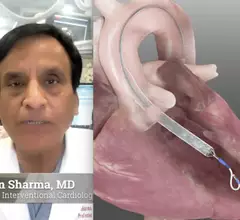 Samin Sharma, MD, director of interventional cardiology and director of clinical cardiology, Mount Sinai Hospital, New York, discusses the first-in-human use of the Magenta Elevate percutaneous left ventricular assist device (pLVAD) with a small 10 French size and 5.5 liters per minute of hemodynamic support.