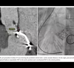 TAVR after mitral valve replacement 