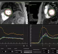 An example of cardiac MRI myocardial blood flow reserve (MBFR) imaging. Image courtesy of https://doi.org/10.3390/diagnostics10090679