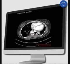 Avicenna.AI, a French artificial intelligence (AI) startup co-founded by a radiologist, has received U.S. Food and Drug Administration (FDA) clearance for two new offerings designed to automatically identify cardiovascular findings in CT scans, CINA-iPE and CINA-ASPECTS. 