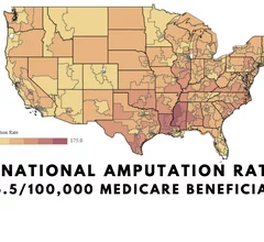 Map of Congressional districts and the rate of amputations based on medicare data showing Mississippi delta region with the highest number of amputation procedures per year. Dr. Fakorede located his practice there to try and combat extremely the high PAD and CLI rates.