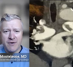 Video of Peter Monteleone, MD, discusses role of cardiology in pulmonary embolism response teams (PERT). CT image of the heart showing bilateral pulmonary embolism blood clots in the pulmonary arteries leading into the lungs.