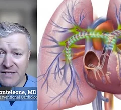 Video interview with Peter Monteleone, MD, explaining the primary catheter-based interventional tools used to treat pulmonary embolism (PE). 