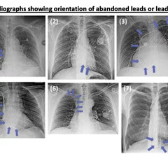 Some of the abandoned leads and various shapes and positions of the wires from the study. None of these patients had any safety issues related the abandoned leads. Image courtesy of RSNA