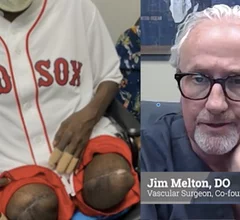 Video interview with Jim Melton, DO, vascular surgeon, explains the CLI mortality rate among amputees in rural Oklahoma, and the need for outreach programs to screen more patients.