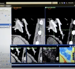 Example of pulmonary embolism (PE) detection on CT and confirmed using spectral CT. Image courtesy of Philips Healthcare