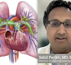 Video interview with Sahil Parikh, MD, FSCAI, director of endovascular services, New York-Presbyterian Columbia University Irving Medical Center and associate professor of medicine at Columbia University, who discusses the disparities in PE treatments in the REAL-PE study