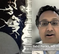 Sahil Parikh, MD, FSCAI, Director of Endovascular Services at New York-Presbyterian Columbia University Irving Medical Center, and Associate Professor of Medicine at the Columbia University College of Physicians and Surgeons, explains there is scant clinical data on what the standard of care should be for pulmonary embolism, so it is up to clinicians to decide what is best for patients based on whether patients have mild to severe PE.