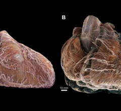 Researchers with University College London and the European Synchrotron Radiation Facility (ESRF) have used a new X-ray technique, hierarchical phase-contrast tomography (HiP-CT), to capture images of the human heart in unprecedented detail. The group shared its images, as well as a full analysis, in Radiology.[1]