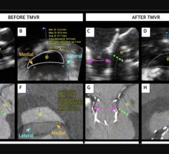 Echocardiography vs CT for Prediction of Newly Created LVOT Area during TMVR