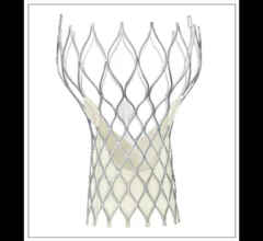 Medtronic CoreValve TAVR first-generation transcatheter heart valve