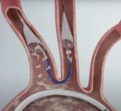 Boston Scientific's Sentinel Cerebral Protection System during a TAVR procedure