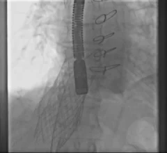 first-in-man valve-in-valve caval valve implantation