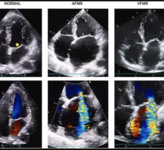 Treating atrial functional mitral regurgitation (AFMR) with surgery may be more beneficial than medical therapy alone, according to new data published in JAMA Network Open.[1]