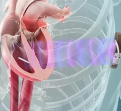 The MODULAR ATP study demonstrated a high rate of successful leadless pacemaker implantation with few complications and stable pacing parameters. The system uses the Emblem Subcutaneous Implantable Defibrillator (S-ICD) System and the new Empower Leadless Pacemaker from Boston Scientific.