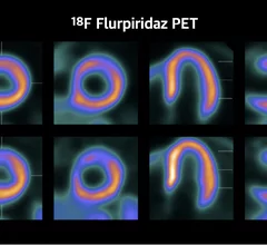 The new cardiac PET radiotracer flurpiridaz F-18 is posed to be a major game changer and will likely lead to increased adoption of cardiac PET.