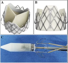 Performing transcatheter aortic valve replacement (TAVR) with the J-Valve transcatheter heart valve (THV) may help limit the risk of coronary artery obstruction (CAO) in high-risk patients, according to a new study published in Clinical Interventions in Aging.[1]